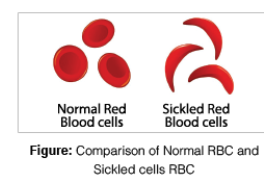 sickle-cell anaemia