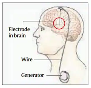 Deep-Brain Stimulation