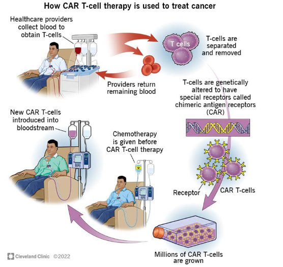 CAR-T सेल थेरेपी
