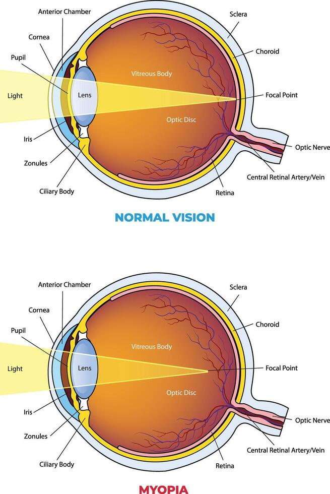 myopia pandemic